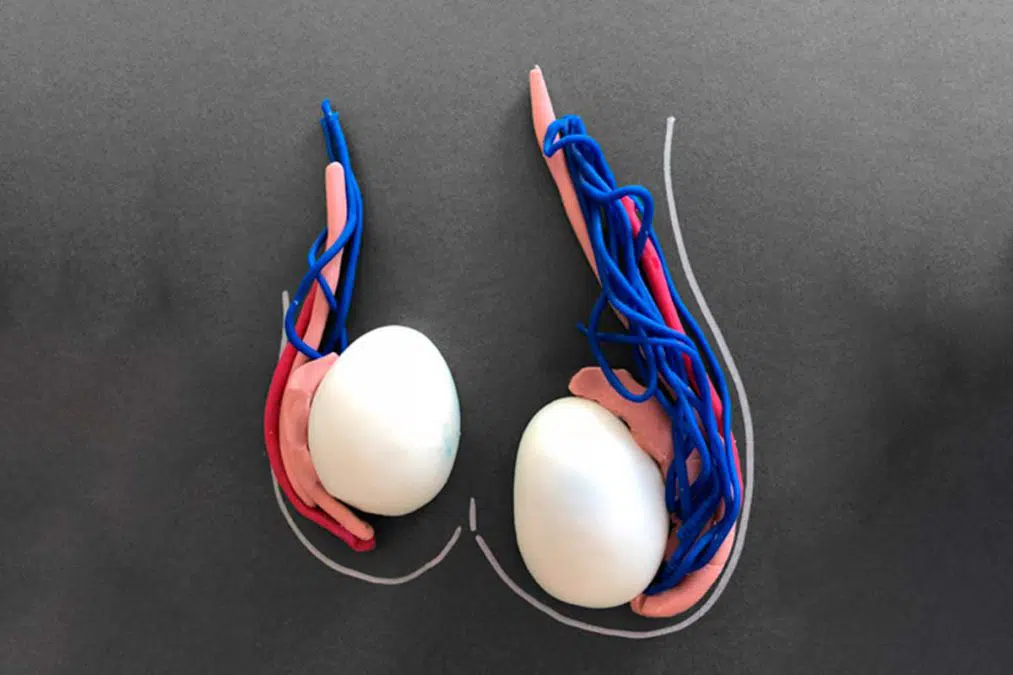 ¿Qué es el varicocele y cuando debe operarse?